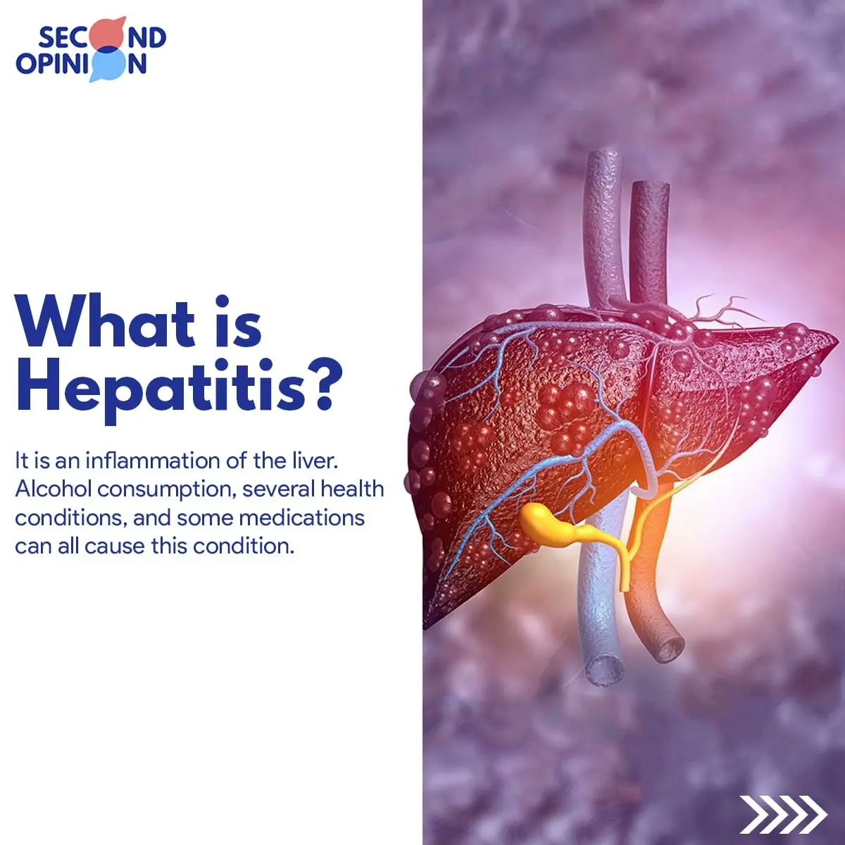 2ndOpinion__: Hepatitis means inflammation of the liver.The liver is a vita...
