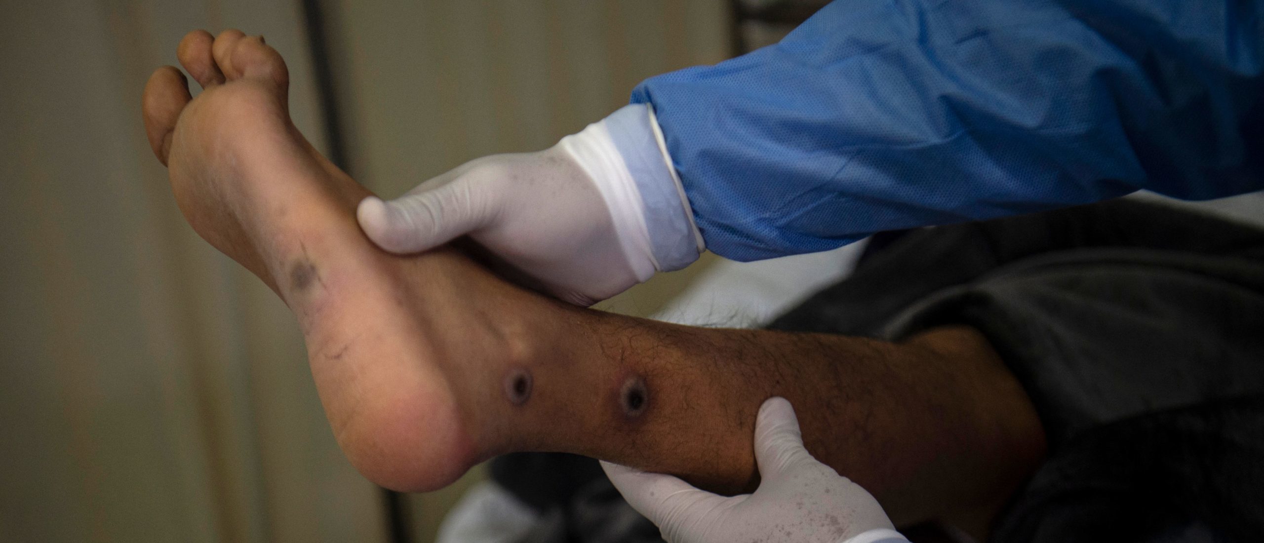 Actually, Yes, Monkeypox Is Likely An STD, Scientists Say