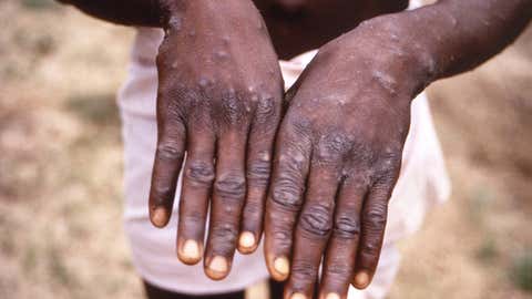 Hands of a monkeypox case patient (CDC/ Brian W.J. Mahy)