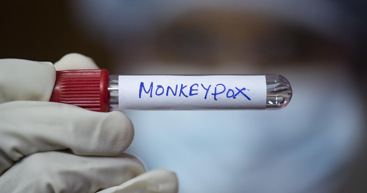 San Francisco monkeypox patient urges new prevention messaging beyond STD a...