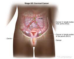 CavesburyH: Cervical Cancer: 45 Frequently Asked Questions  
Questions 36-4...
