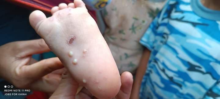 @Aung_Soe_Lwin_M: Kayah (Karenni) State It is reported that herpes skin dis...