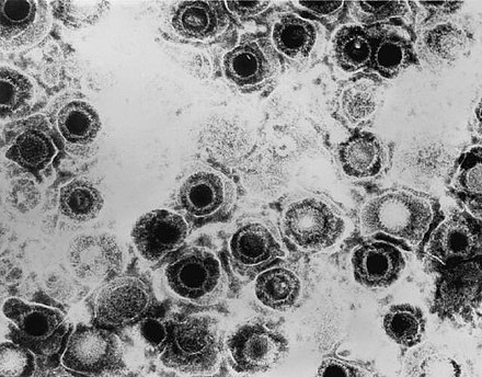 TEM micrograph of virions of a herpes simplex virus species PHOTO CREDIT: Wikipedia