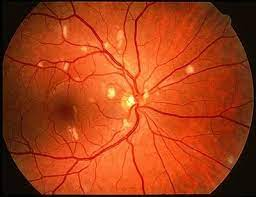 @AZretinaproject: HIV retinopathy is spotty vision due to blood pooling in ...